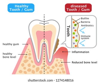 Healthy And Diseased Gum. Oral Biofilm. Dental And Health Care Concept
