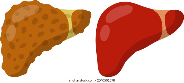 Healthy and diseased liver. Medical element. Biology and education. Health problem. Comparison of two internal organs of a person