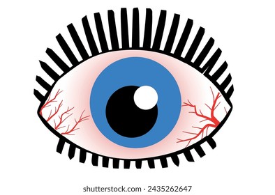 Ojo humano sano y seco. El globo ocular normal e inflamado con irritación y conjuntiva roja. Síntomas de queratitis, alergia, conjuntivitis, uveítis. Ilustración de dibujos animados.