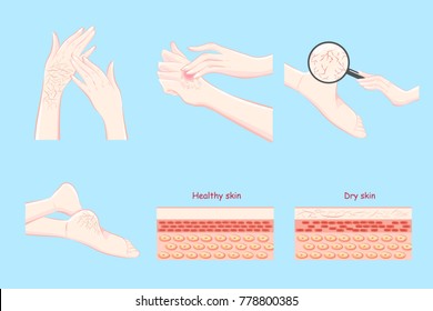 healthy with dry skin concept on the blue background