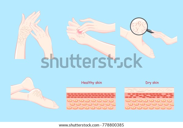 Healthy Dry Skin Concept On Blue Stock Vector (Royalty Free) 778800385 ...