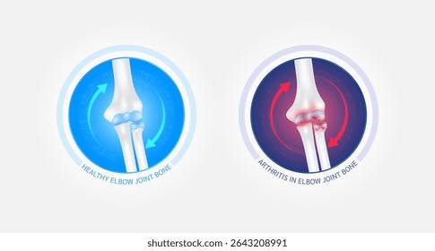 Healthy elbow bone and arthritis or osteoporosis with red blue arrows spin around. Joint cartilage becomes worn. Comparative images of normal and inflammation bones. Vector EPS10.