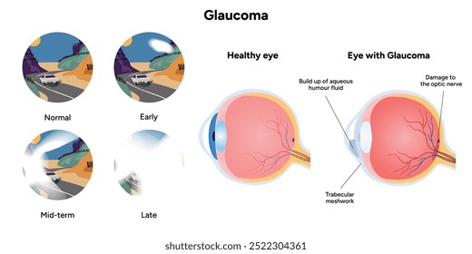 Olho e olho saudáveis com anatomia do glaucoma. Glaucoma precoce, médio e tardio