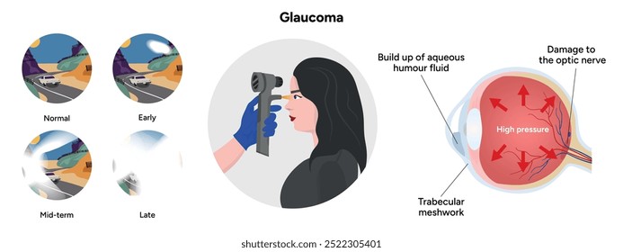 Olho e olho saudáveis com anatomia do glaucoma. Teste oftalmológico ocular. Glaucoma precoce, médio e tardio