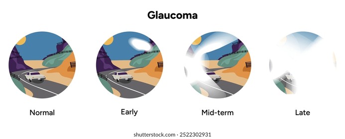 Olho e olho saudáveis com glaucoma. Glaucoma precoce, médio e tardio