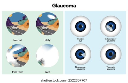 Healthy eye and eye with glaucoma. Early, mid-term and late glaucoma