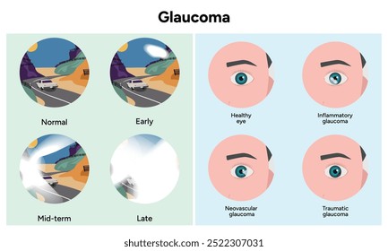 Healthy eye and eye with glaucoma Inflammatory. Neovascular.Traumatic glaucoma. Early, mid-term and late glaucoma