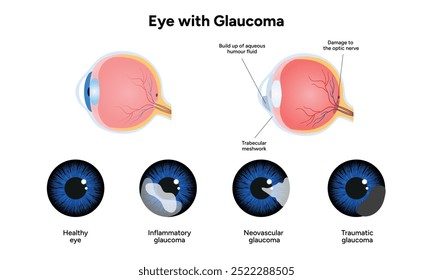 Olho e olho saudáveis com glaucoma. Oftalmologia e anatomia do olho. Glaucoma inflamatório.
Glaucoma neovascular.
Glaucoma traumático