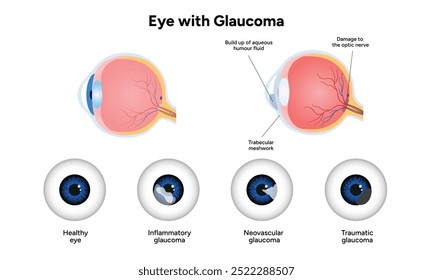 Olho e olho saudáveis com glaucoma. Oftalmologia e anatomia do olho. Glaucoma inflamatório.
Glaucoma neovascular.
Glaucoma traumático