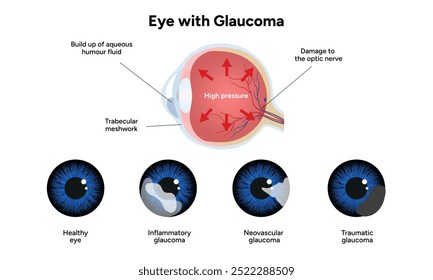 Olho e olho saudáveis com glaucoma. Oftalmologia e anatomia do olho. Glaucoma inflamatório.
Glaucoma neovascular.
Glaucoma traumático