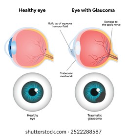 Olho e olho saudáveis com glaucoma. Oftalmologia e anatomia do olho. 
Glaucoma traumático