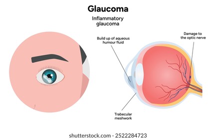 Olho e olho saudáveis com glaucoma. Diagrama oftalmológico e anatomia. Glaucoma inflamatório