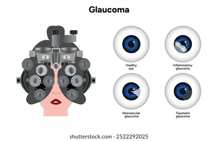 Healthy eye and eye with glaucoma. Ophthalmology eye testing. Inflammatory glaucoma.
Neovascular glaucoma.
Traumatic glaucoma