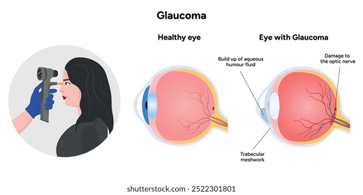 Olho e olho saudáveis com glaucoma. Teste oftalmológico ocular