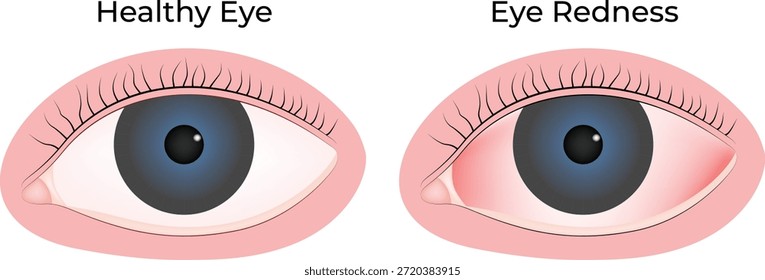 Olho Saudável vs Olho Vermelho Uma Comparação Visual das Condições Oculares