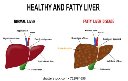 Healthy and fatty liver, vector illustration (for basic medical education, for clinics & Schools)