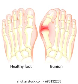 Healthy foot and foot with Bunion. Human anatomy. Skeleton