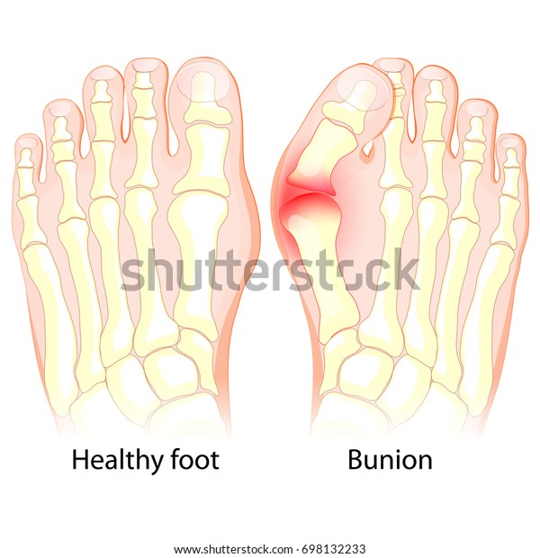 健康的足部和足部与bunion 人体解剖学骨架库存矢量图 免版税