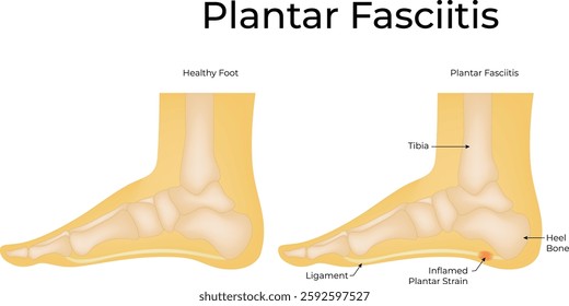 Healthy Foot and Plantar Fasciitis Foot Science Design Illustration Diagram