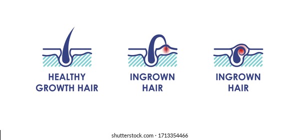 Healthy growth hair. Ingrown hair. Vector icons for your design