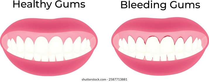 Healthy Gums Bleeding Gums Science Design Vector Illustration Diagram