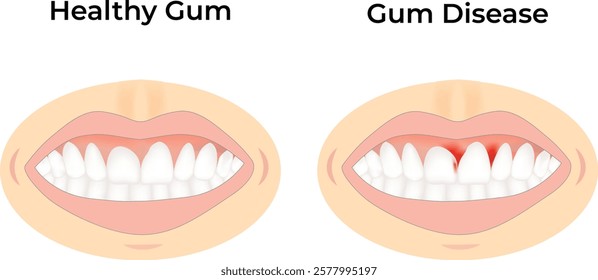 Healthy Gums vs Gum Disease Design Vector Illustration