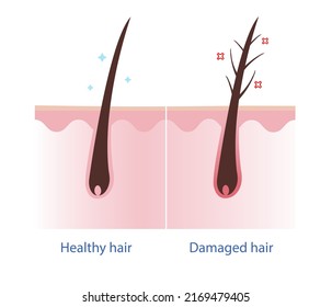 Healthy Hair Damaged Hair Scalp Layer Stock Vector (Royalty Free ...