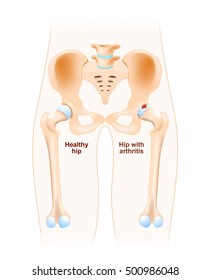 Healthy hip and hip with osteoarthritis. Arthritis or pain within a joint. degenerative joint disease. Cartilage becomes worn. This results in inflammation, swelling, and pain in the joint.