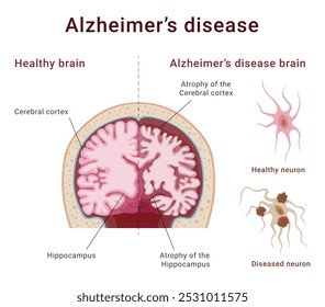 Cérebro humano saudável e doença de Alzheimer seção transversal esquema infográfico vetor ilustração plana. Diagrama da ciência da anatomia médica neurologia do sistema nervoso demência do sistema nervoso degeneração do nervo