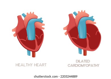 Healthy Human Heart Heart Dilated Cardiomyopathy Stock Vector (Royalty ...