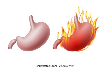 Estomago humano saludable y estómago quemante. Órgano realista del sistema de digestión interna en llamas. Quema de corazón digestivo, dolor gástrico o esófago. Ilustración del vector