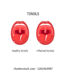 41 Normal and inflamed tonsils Images, Stock Photos & Vectors ...