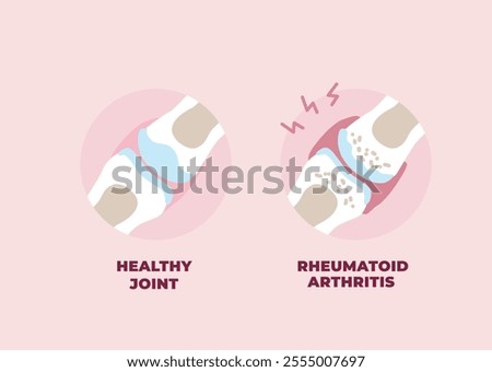 Healthy and inflamed joint affected by Rheumatoid Arthritis. Vector illustration in flat style.