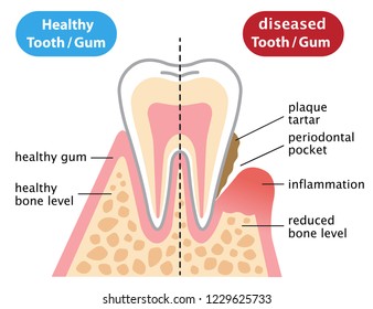 healthy and inflammatory diseased gum illustration. dental and health care concept