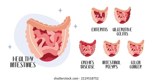 Healthy intestines. Gut diseases: enteritis, ulcerative colitis, Crohn's disease, polyp, colon cancer. Gastroenterology. Vector flat cartoon illustration. Perfect for medical flyer, brochure