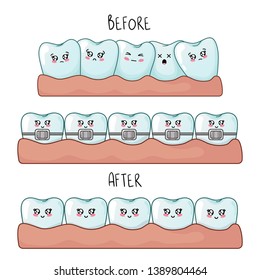 Healthy kawaii teeth are together and dental braces, cute cartoon characters, concept of dentistry and orthodontics, teeth treatment, oral hygiene and dental care. Vector flat