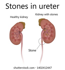 Stones Ureter Kidney Realistic Anatomy Vector Stock Vector (Royalty ...