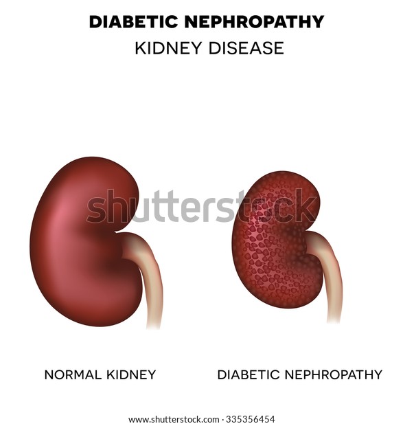 Healthy Kidney Nephropathy Disease Caused By Stock Vector (Royalty Free ...