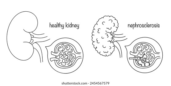 A healthy kidney and a kidney with nephrosclerosis. Kidney damage, which consists in reducing its size and gradually replacing it with fibrous tissue. Medical illustration for different uses.