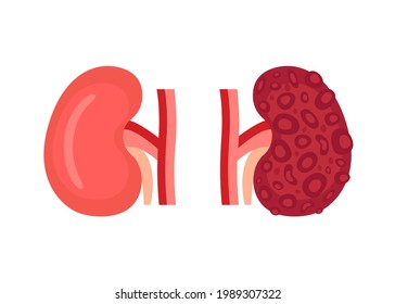 Healthy kidney and unhealthy disease kidney with polycystic. Check health of renal organ. Internal organ kidney. Vector illustration