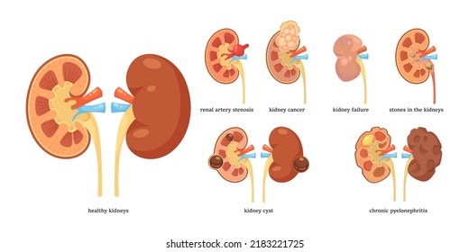 Healthy kidneys and different diseases vector illustrations set. CKD, kidneys tumor, renal artery stenosis, cancer, cyst, stones isolated on white background. Health, anatomy, medicine concept
