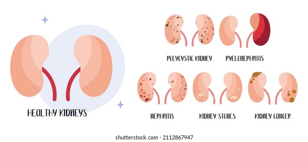 Types Kidneys Stones Oxalate Phosphate Xanthine Stock Vector (Royalty ...