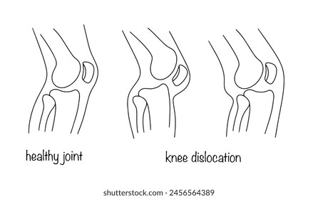 Healthy knee and knee dislocation. Displacement of the femur. Medical illustration. Human anatomy.