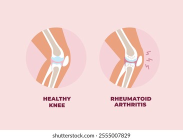 Healthy knee and inflamed knee joint affected by Rheumatoid Arthritis. Vector illustration in flat style.