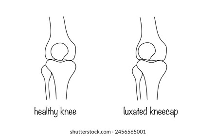 Rodilla sana y rótula dislocada. Lesión en la que la rótula se extiende más allá de los límites fisiológicos de la articulación de la rodilla. Ilustración vectorial.