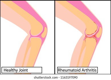 Healthy knee joint and Rheumatoid arthritis vector illustration on a white background