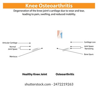 Healthy knee joint versus osteoarthritis-affected knee joint