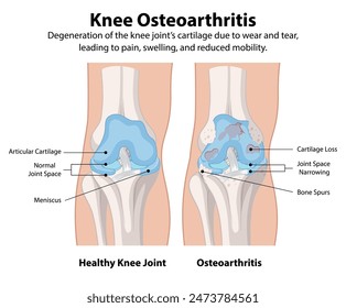 Healthy knee joint vs osteoarthritis knee joint