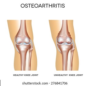 Healthy knee and knee with osteoarthritis on a white background