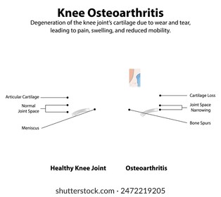 Healthy knee vs osteoarthritis-affected knee diagram